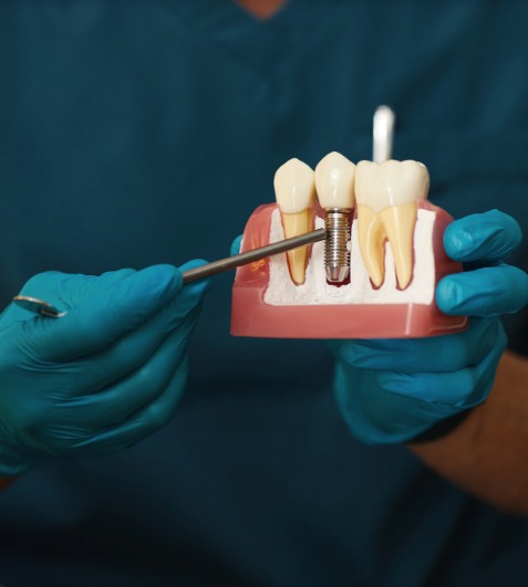 Dental Implants